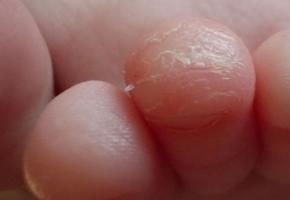 Сухая кожа на руках и ногах - причины и лечение